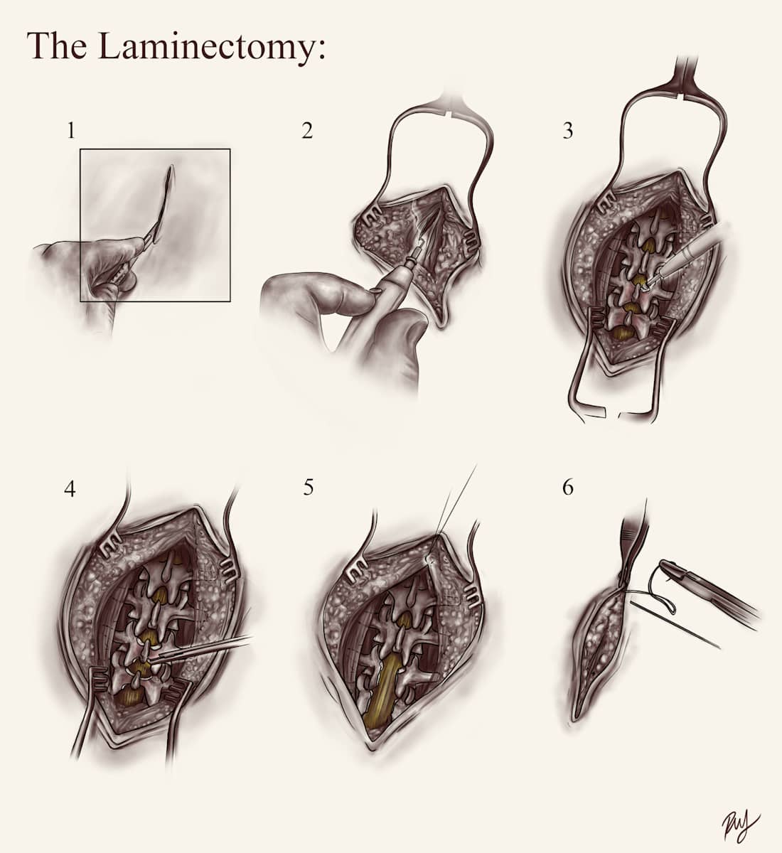 Laminectomy by Becca Lewis, Image 3.