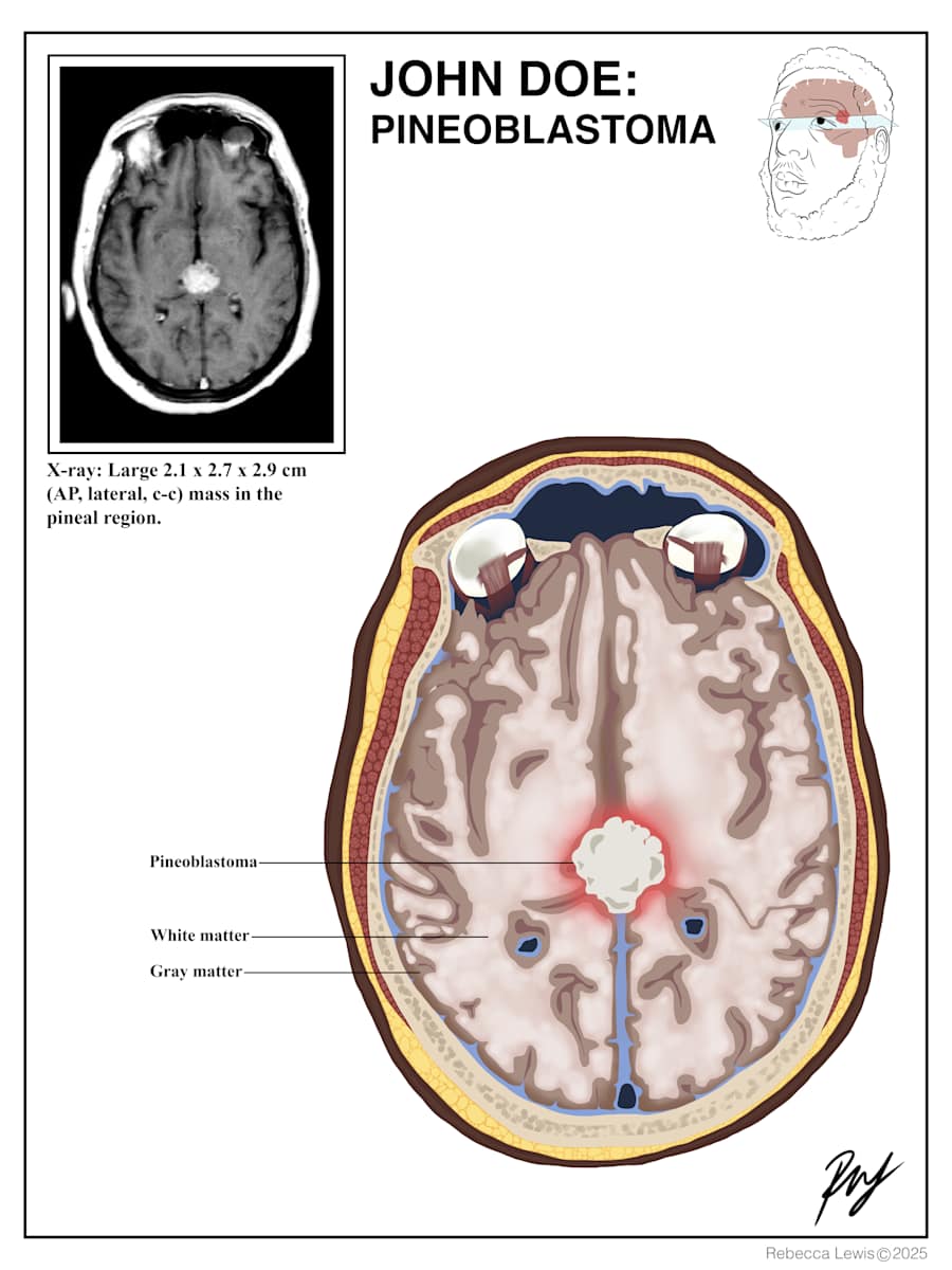 Pineoblastoma by Becca Lewis  Image: An example of a medical legal case for a pineoblastoma. 