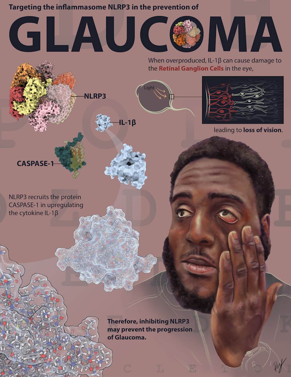 Glaucoma by The Art of Dissection, Image 1.