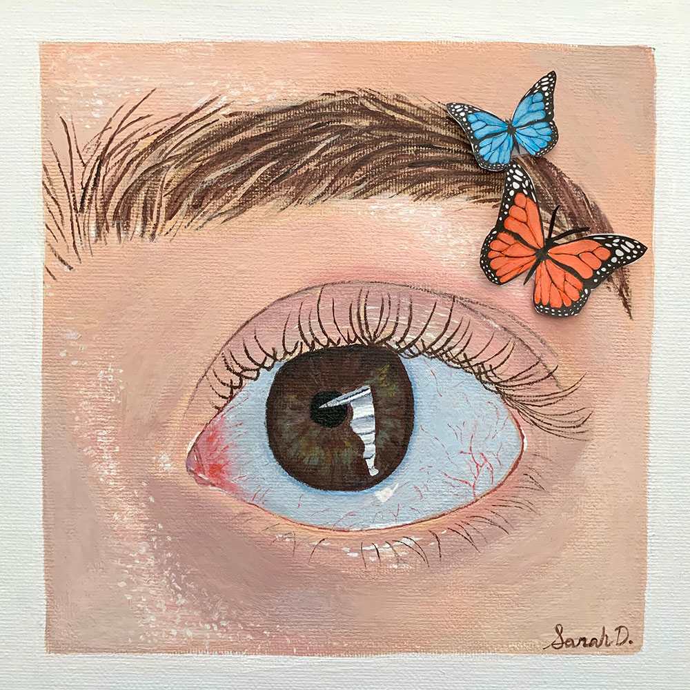 Behind The Eye by Sarah Dillon - Thyroid Eye Disease, Image 1.