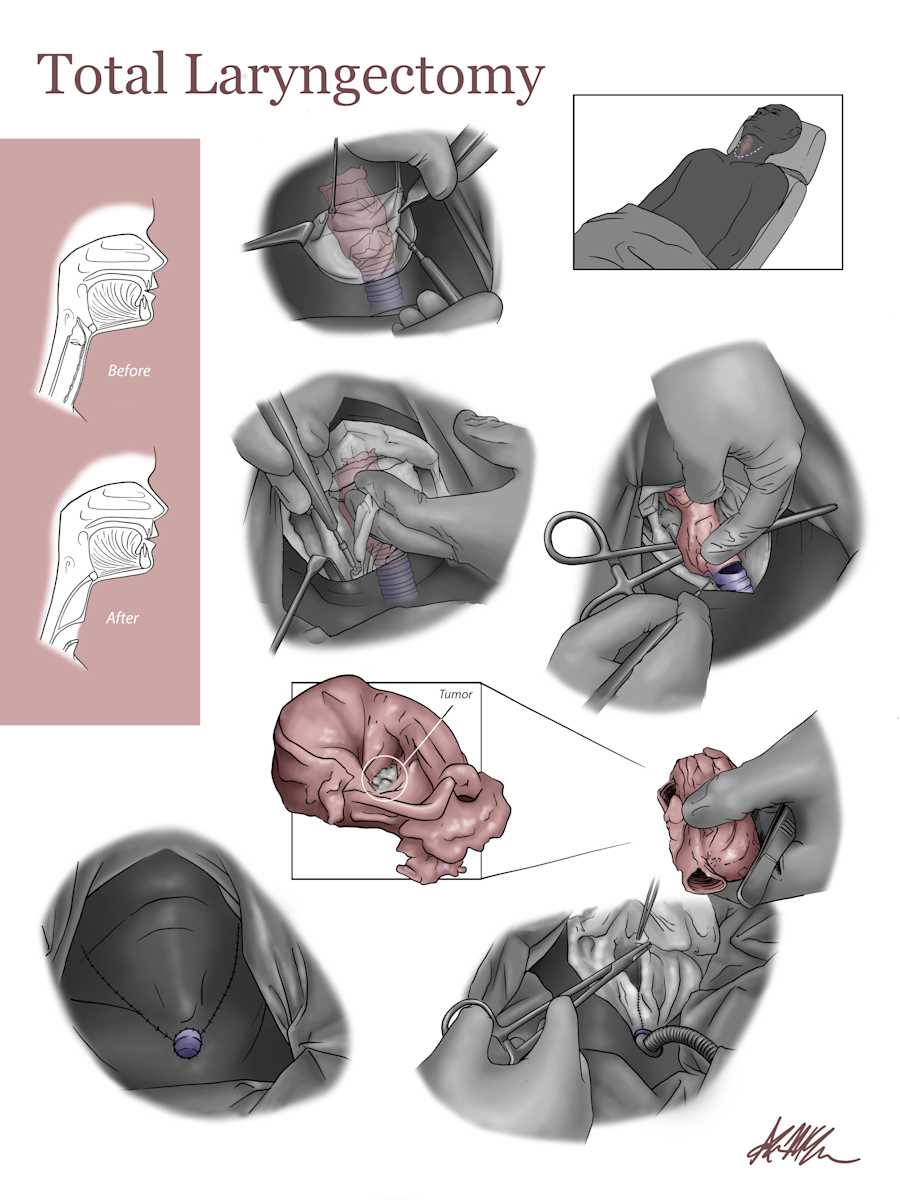 Total Laryngectomy by Adyson McCullough  Image: Surgical Illustration