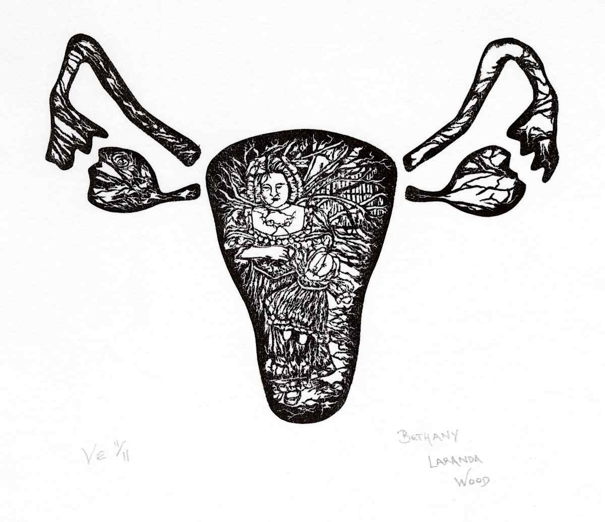 R-Hysterectomy: Impression VE 11/11 by Bethany Laranda Wood 