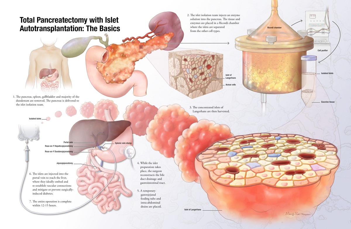 Total Pancreatectomy and Islet Auto transplantation by Mandy Root-Thompson 