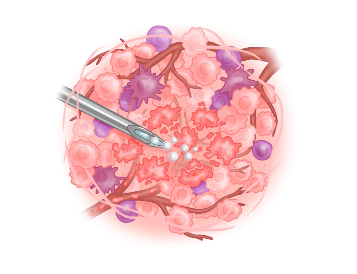 Tumor Gas Injection by Caitlin Rausch 