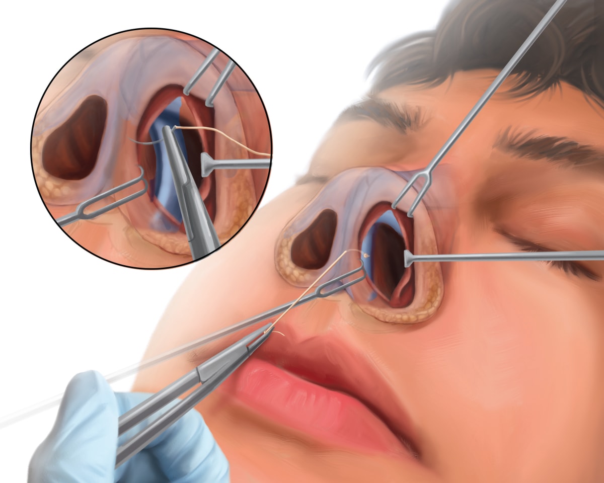 Facial Trauma Surgery Diagram - Nose by Caitlin Rausch 