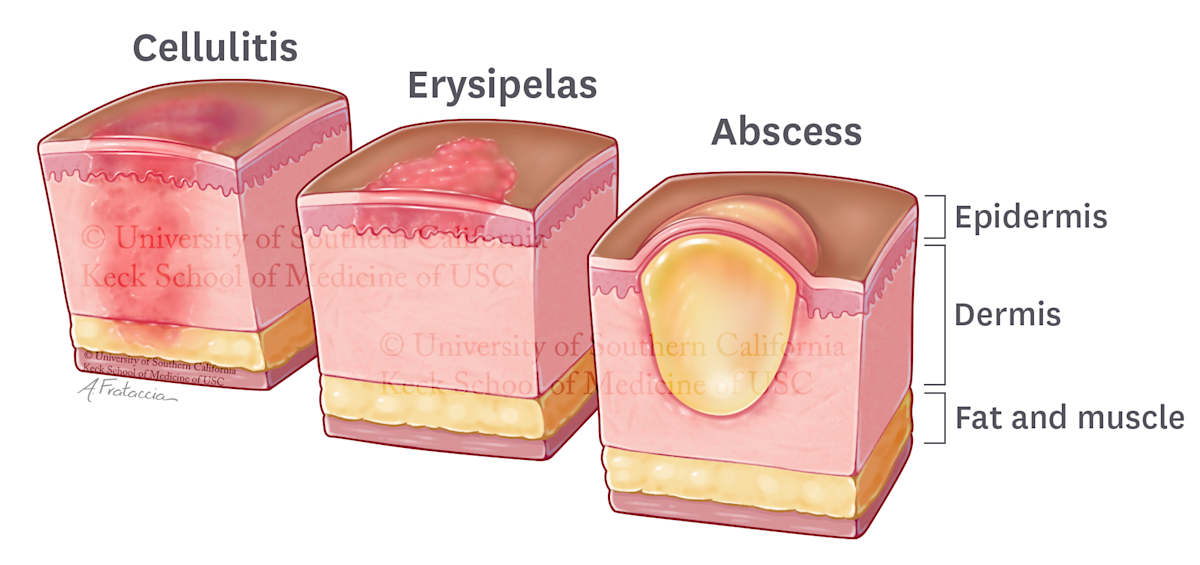 Skin Infections by Amanda Frataccia 