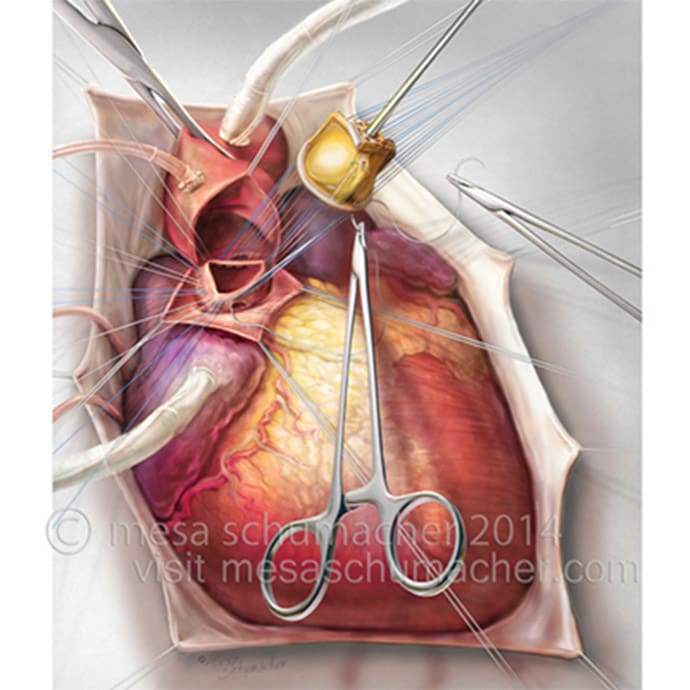 Heart surgery by Mesa Schumacher 
