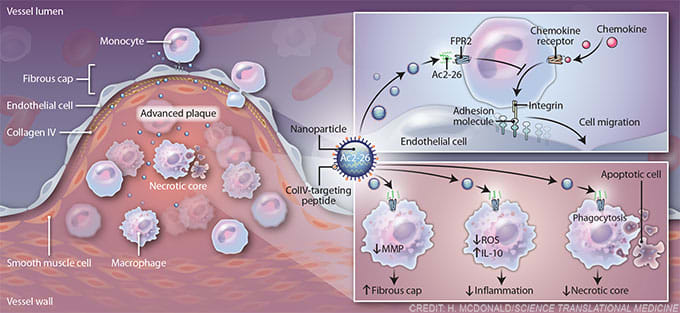 Treating advanced atherosclerosis by Heather McDonald 