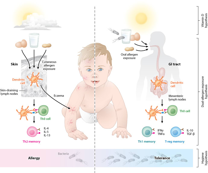 Vitamin D, Hygiene, and Allergen Exposure by Fiona Martin 