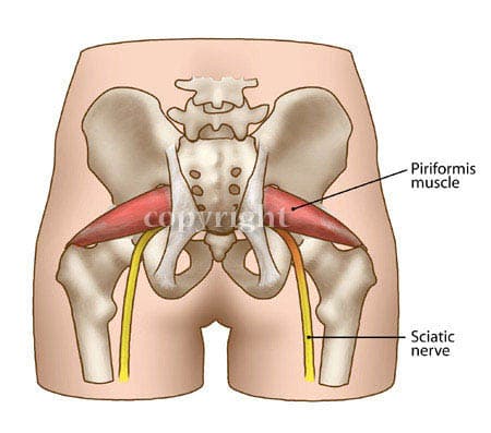 Piriformis Syndrome by Lisa Wable 