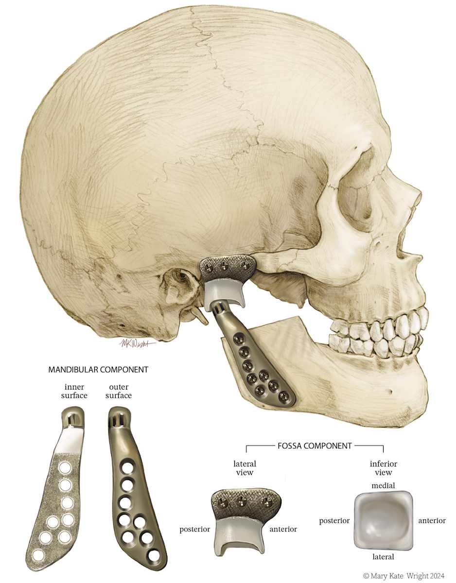 TMJ Prosthesis by Mary Kate Wright 