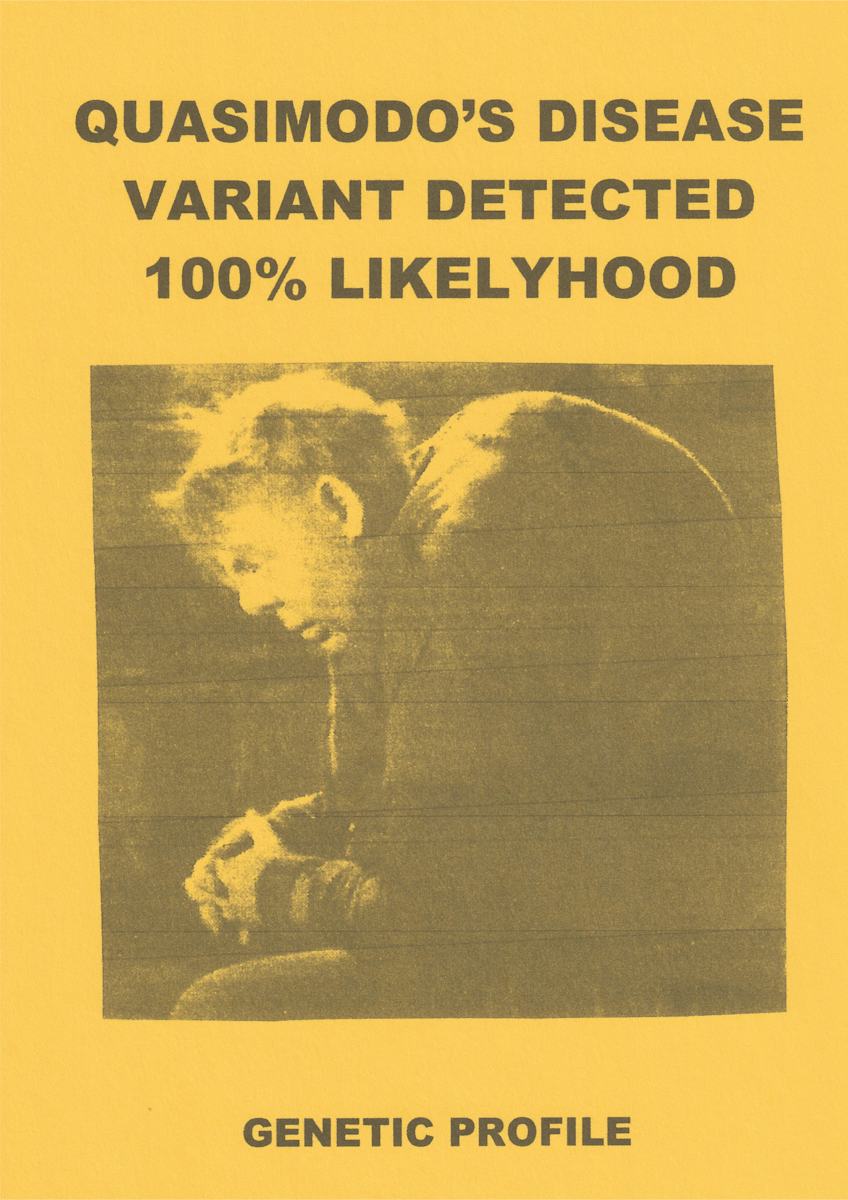 QUASIMODO'S DISEASE by charles elwert  Image: HEARTBREAK