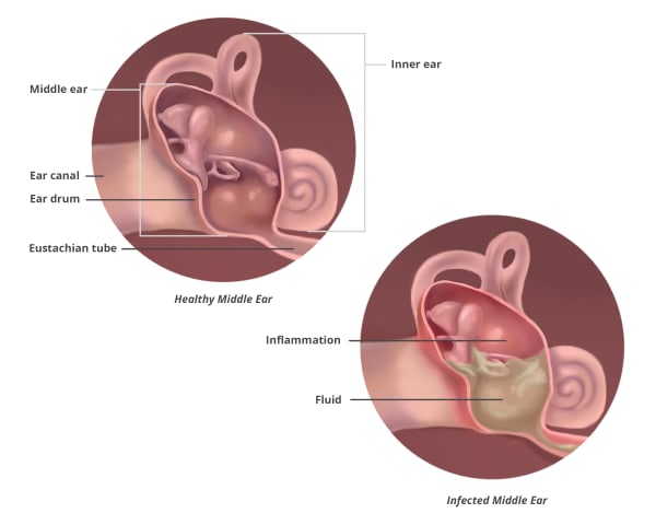 Ear Infection from the collection of Guild of Natural Science ...