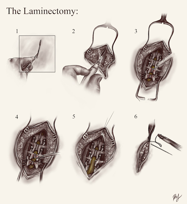 Laminectomy by Becca Lewis