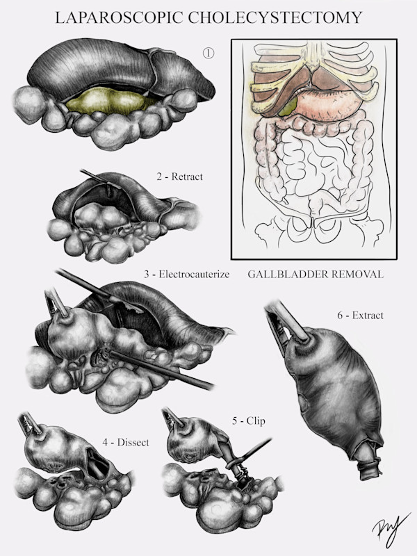 Laparoscopic Cholecystectomy by Becca Lewis