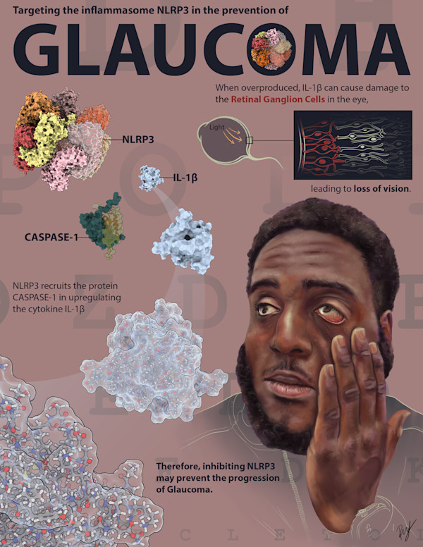 Glaucoma by Becca Lewis
