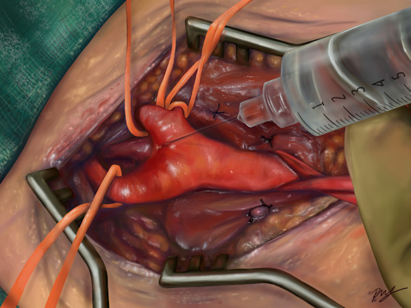 Carotid endarterectomy illustration by Becca Lewis