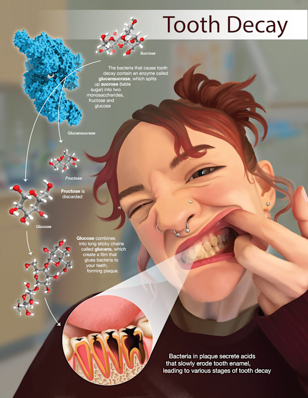 Tooth Decay by Adyson McCullough