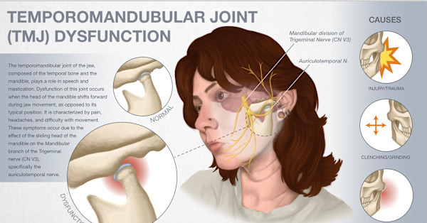 Temporal Mandibular Joint Dysfunction by Adyson McCullough