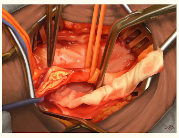 Carotid Endarterectomy by Adyson McCullough