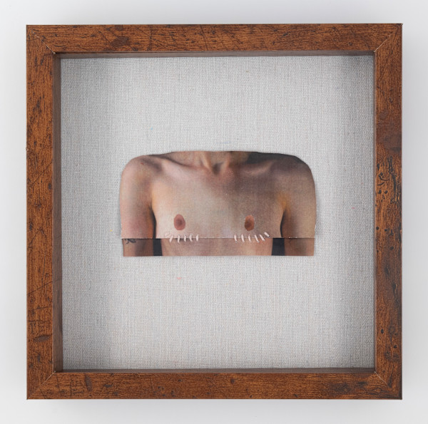 An Exercise in Prospective Double-Incision Top Surgery by Alexander Berning
