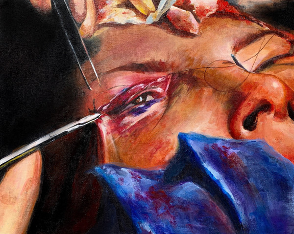 Double Eyelid Surgery by Jennifer Wu