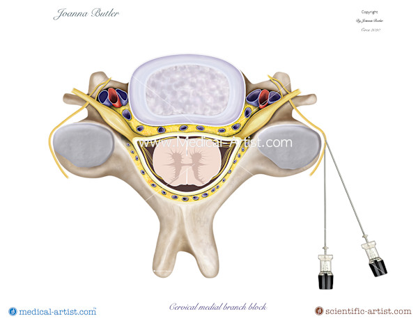 Cervical medial branch block in the cervical region by Joanna Butler