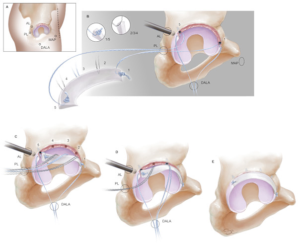 Arthroscopic labrum reconstruction with meniscus by Stacy Cheavens