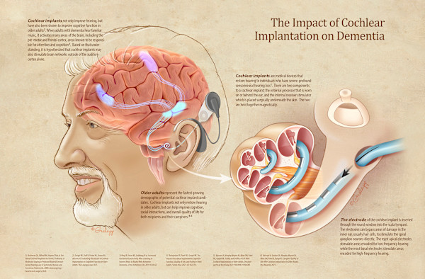 The Impact of Cochlear Implantation on Dementia by Chris Gralapp