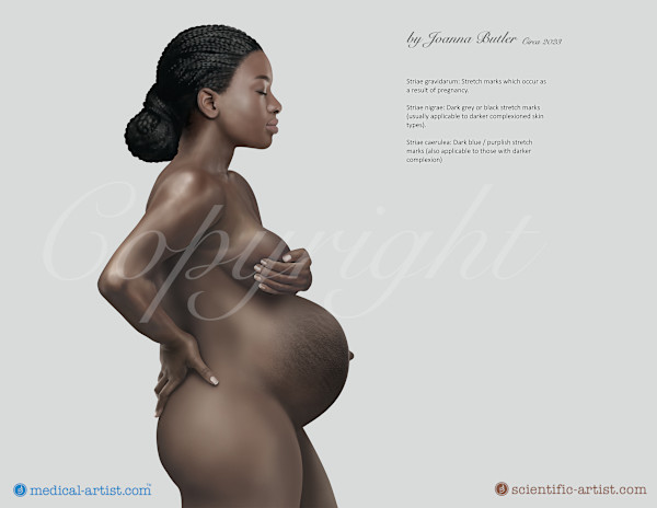 Stretch Marks as Shown on Skin of an African Female by Joanna Butler