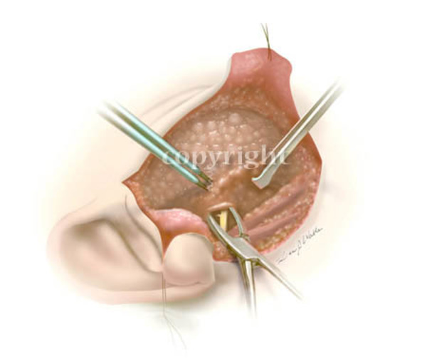 Parotid resection by Lisa Wable