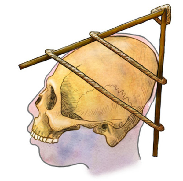 Wari skull cranial modification by Mesa Schumacher
