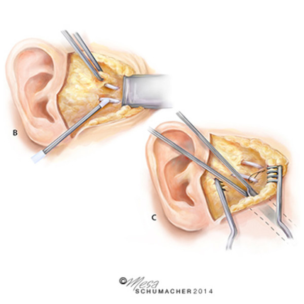 Ear and facial nerve surgery by Mesa Schumacher
