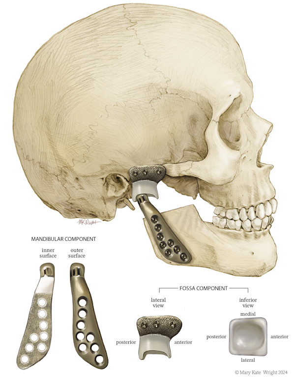 TMJ Prosthesis by Mary Kate Wright