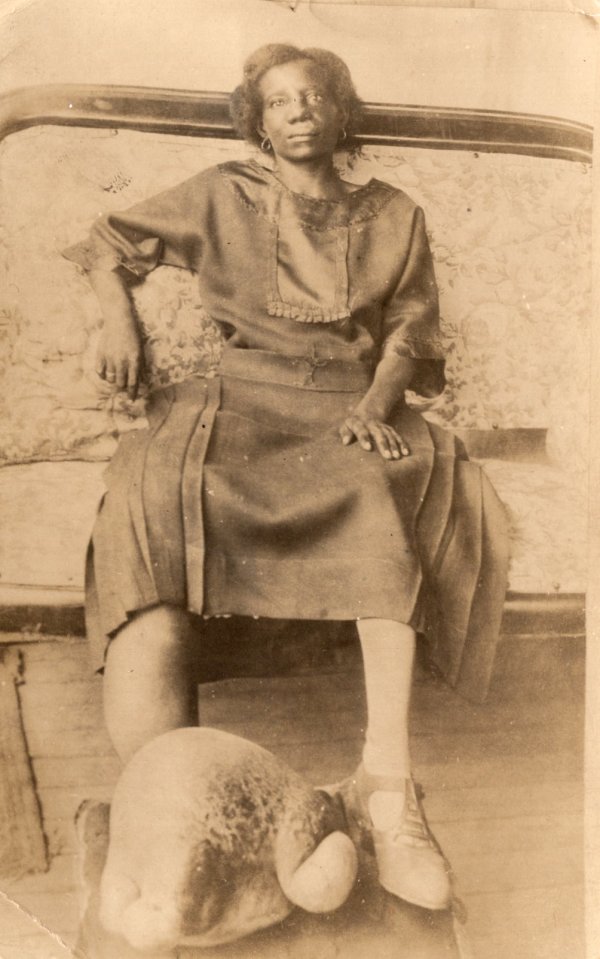 Woman with Elephantiasis by Unknown