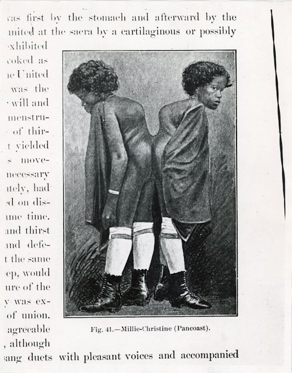 Millie-Christine McKoy (July 11, 1851 - October 8, 1912) by Unknown