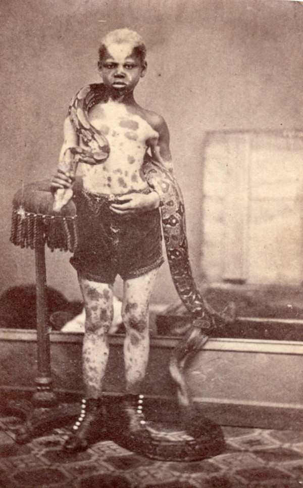 Piebald boy with snake by Unknown
