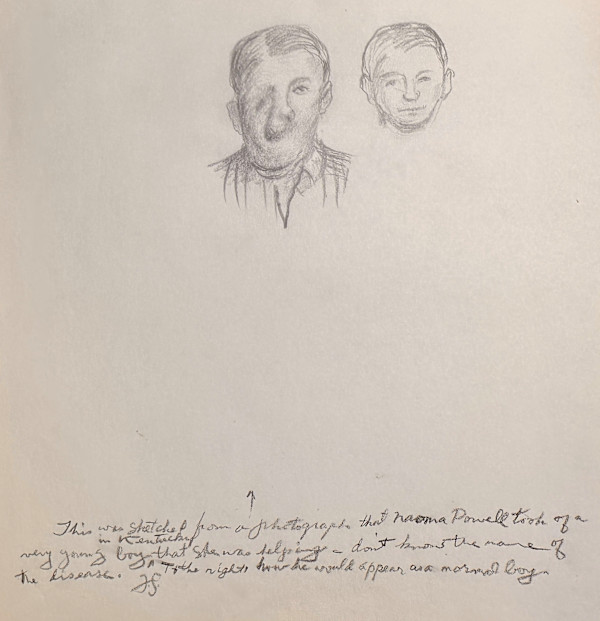 "Young Boy with Facial Malformities" named by CLL by Fred Shane, Image 1.