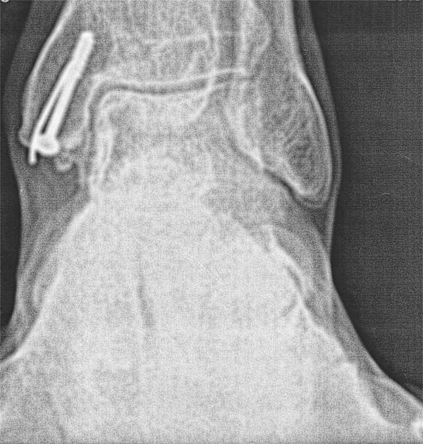 PLANTAR FLEXION>>>DORSIFLEXION by charles elwert