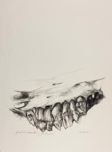 Fracture
