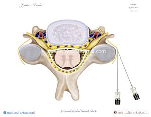 Cervical medial branch block in the cervical region