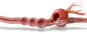 Fibromuscular Dysplasia