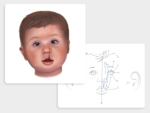 Cleft Lip/Palate Diagram