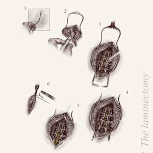 Laminectomy by Becca Lewis 