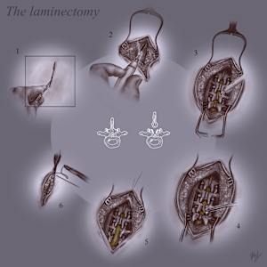 Laminectomy by Becca Lewis 