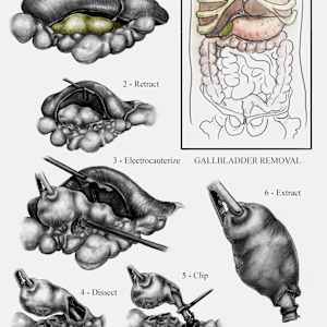 Laparoscopic Cholecystectomy by The Art of Dissection, Image 2.