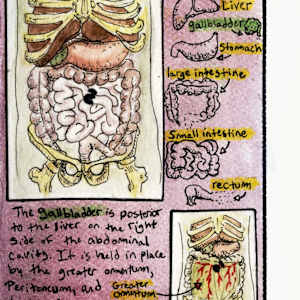 What the Hell is a Laparoscopic Cholecystectomy?? by Becca Lewis 