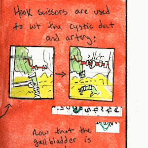 What the Hell is a Laparoscopic Cholecystectomy?? by Becca Lewis 