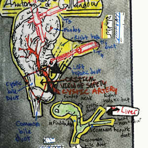 What the Hell is a Laparoscopic Cholecystectomy?? by Becca Lewis 