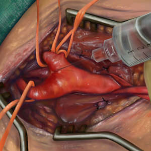Carotid endarterectomy illustration by Becca Lewis, Image 1.